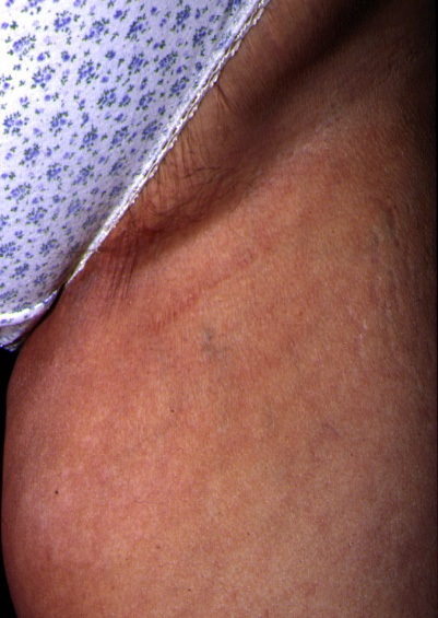 Descente progressive d’une incision inguinale de crossectomie réalisée 25 ans auparavant.