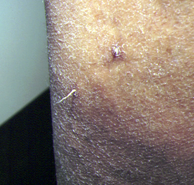 Cicatrices inesthétiques de phlébectomies dûes aux filets de collagène traversant l’incision et empêchant la progression de l’épiderme.
